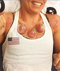 Cupping Natalie Coughlin